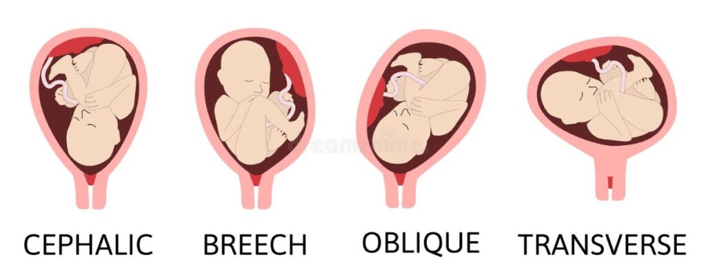 How to Tell What Position Baby is in With a Fetal Ultrasound